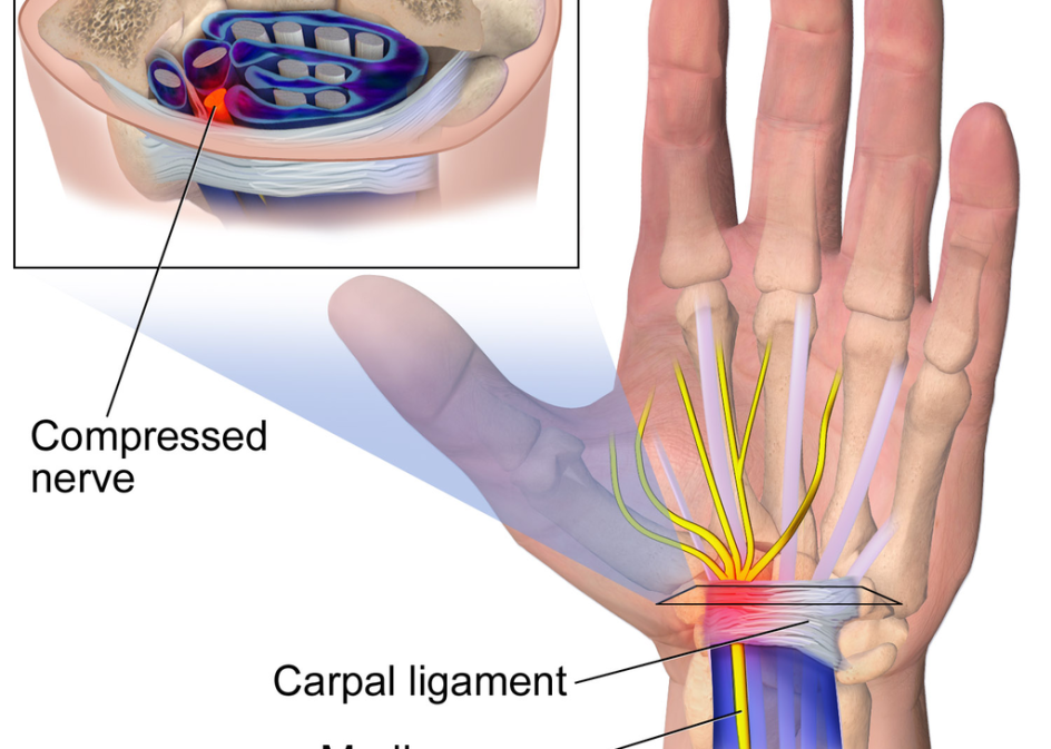 Carpal tunnel syndrome