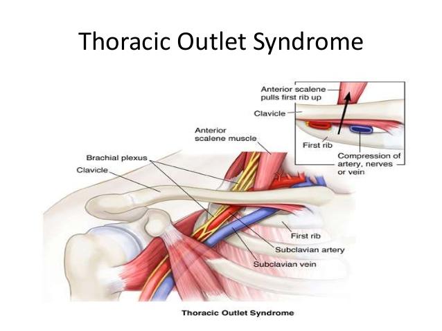 Thorasic outlet syndrome